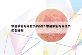 银屑病能吃点什么药会好 银屑病能吃点什么药会好呢