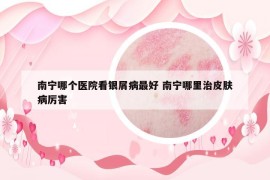 南宁哪个医院看银屑病最好 南宁哪里治皮肤病厉害