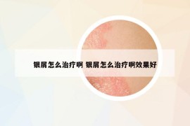 银屑怎么治疗啊 银屑怎么治疗啊效果好