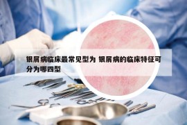 银屑病临床最常见型为 银屑病的临床特征可分为哪四型