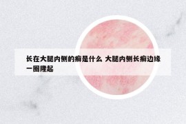 长在大腿内侧的癣是什么 大腿内侧长癣边缘一圈隆起