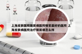 上海皮肤医院银屑病医院哪家最好的医院 上海皮肤病医院治疗银屑病怎么样