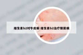 维生素b2对牛皮癣 维生素b2治疗银屑病