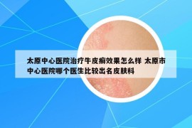 太原中心医院治疗牛皮癣效果怎么样 太原市中心医院哪个医生比较出名皮肤科