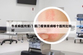 牛皮癣医院厦门 厦门看银屑病哪个医院比较好