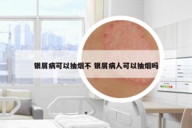 银屑病可以抽烟不 银屑病人可以抽烟吗