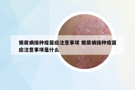 银屑病接种疫苗应注意事项 银屑病接种疫苗应注意事项是什么