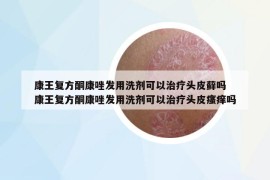 康王复方酮康唑发用洗剂可以治疗头皮藓吗 康王复方酮康唑发用洗剂可以治疗头皮瘙痒吗