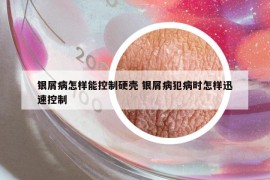 银屑病怎样能控制硬壳 银屑病犯病时怎样迅速控制