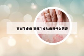 面碱牛皮癣 面部牛皮肤癣用什么药膏