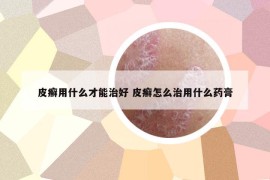 皮癣用什么才能治好 皮癣怎么治用什么药膏