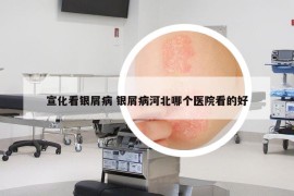 宣化看银屑病 银屑病河北哪个医院看的好