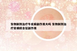 生物制剂治疗牛皮癣副作用大吗 生物制剂治疗肾病综合征副作用