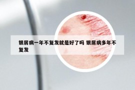 银屑病一年不复发就是好了吗 银屑病多年不复发