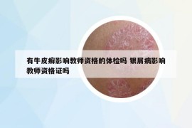 有牛皮癣影响教师资格的体检吗 银屑病影响教师资格证吗