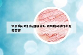 银屑病可以打新冠疫苗吗 银屑病可以打新冠疫苗嘛