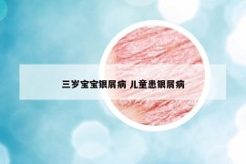 三岁宝宝银屑病 儿童患银屑病