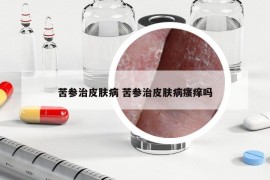 苦参治皮肤病 苦参治皮肤病瘙痒吗