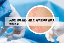 关节型银屑病的x线特点 关节型银屑病累及哪些关节