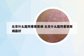 北京什么医院看银屑病 北京什么医院看银屑病最好