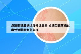 点滴型银屑病过度外涂激素 点滴型银屑病过度外涂激素会怎么样