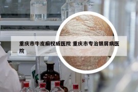 重庆市牛皮癣权威医院 重庆市专治银屑病医院