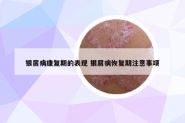 银屑病康复期的表现 银屑病恢复期注意事项