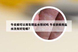 牛皮癣可以用生理盐水擦拭吗 牛皮肤癣用盐水洗有好处嘛?