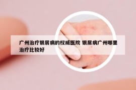 广州治疗银屑病的权威医院 银屑病广州哪里治疗比较好