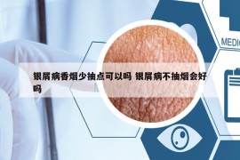 银屑病香烟少抽点可以吗 银屑病不抽烟会好吗