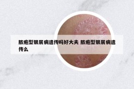 脓疱型银屑病遗传吗好大夫 脓疱型银屑病遗传么