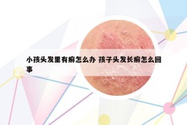 小孩头发里有癣怎么办 孩子头发长癣怎么回事