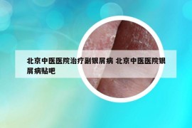 北京中医医院治疗副银屑病 北京中医医院银屑病贴吧