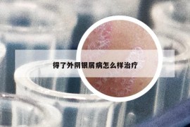 得了外阴银屑病怎么样治疗