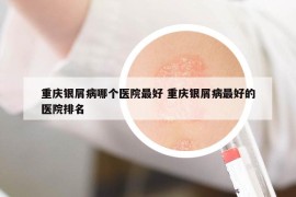 重庆银屑病哪个医院最好 重庆银屑病最好的医院排名