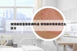 铜钱癣就是银屑病吗通 铜钱癣和银屑病怎么区分