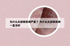 为什么头部银屑病严重了 为什么头部银屑病一直没好