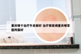 重庆哪个治疗牛皮癣好 治疗银屑病重庆哪家医院最好