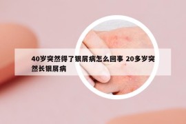 40岁突然得了银屑病怎么回事 20多岁突然长银屑病