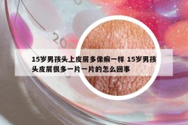 15岁男孩头上皮屑多像癣一样 15岁男孩头皮屑很多一片一片的怎么回事