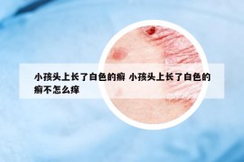 小孩头上长了白色的癣 小孩头上长了白色的癣不怎么痒