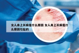 女人身上长癣是什么原因 女人身上长癣是什么原因引起的