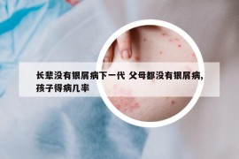 长辈没有银屑病下一代 父母都没有银屑病,孩子得病几率