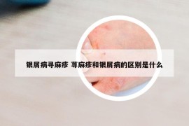 银屑病寻麻疹 荨麻疹和银屑病的区别是什么