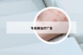 牛皮癣治疗广告