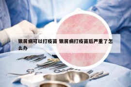 银屑病可以打疫苗 银屑病打疫苗后严重了怎么办