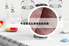 牛皮癣怎么有效去除皮屑