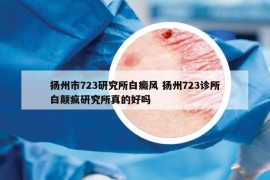 扬州市723研究所白癜风 扬州723诊所白颠疯研究所真的好吗