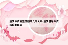 后天牛皮癣遗传孩子几率大吗 后天引起牛皮肤癣的原因