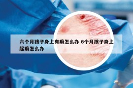 六个月孩子身上有癣怎么办 6个月孩子身上起癣怎么办